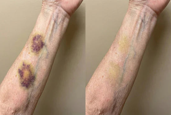 Two forearm marks before and after cosmetic comparison