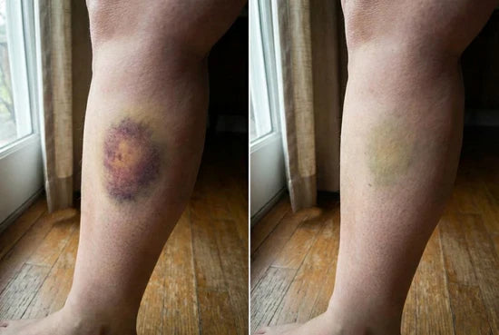 Lower leg before and after cosmetic appearance comparison